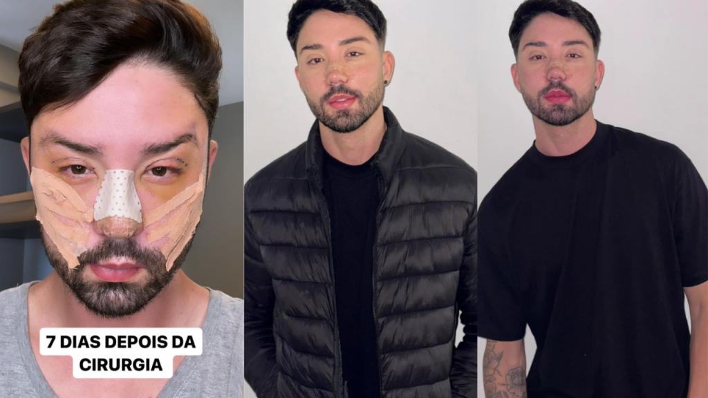 Rico Melquiades Exibe Resultado De Cinco Cirurgias Faciais Celebspe